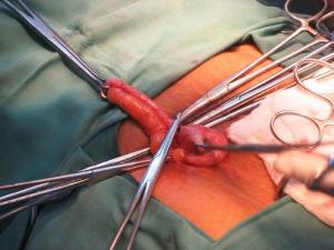 Appendicite nel bambino: segni e trattamento
