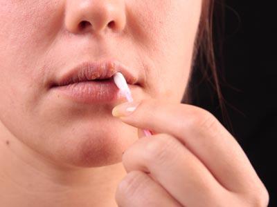 C'è un rimedio per l'herpes sul labbro che può liberarsi definitivamente di questo disturbo?