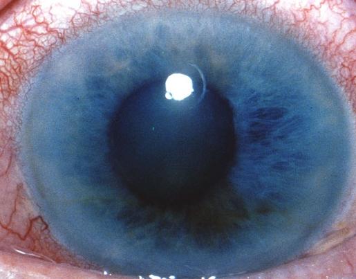 sintomi di glaucoma oculare