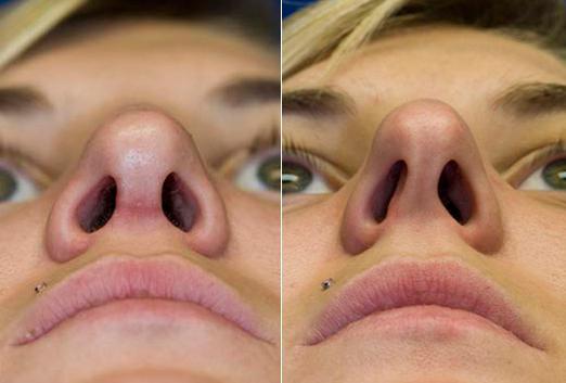 Curvatura del setto nasale: conseguenze e cause